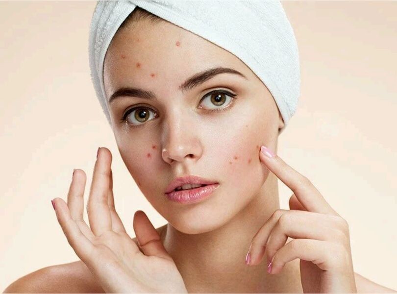 Sivilce(akne) sorunları…