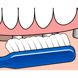 TEPE DIS FIR IMPLANT/ORTHODONT - 2